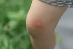 Mosquito Bite