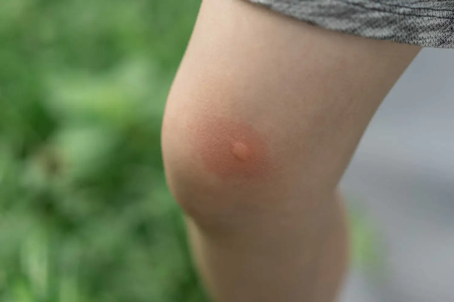 Mosquito Bite